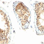 Formalin-fixed, paraffin embedded human testicular carcinoma sections stained with 100 ul anti-Ornithine Decarboxylase-1 (clone ODC1/485) at 1:200. HIER epitope retrieval prior to staining was performed in 10mM Citrate, pH 6.0.